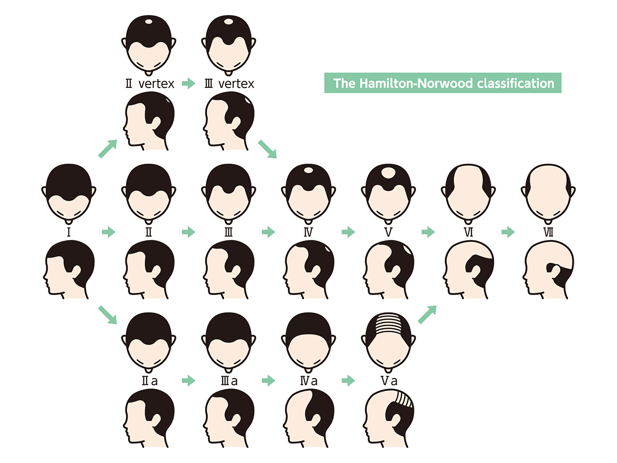AGA症状のハミルトン・ノーウッド分類