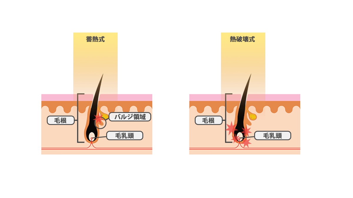 蓄熱式と熱破壊式のレーザー