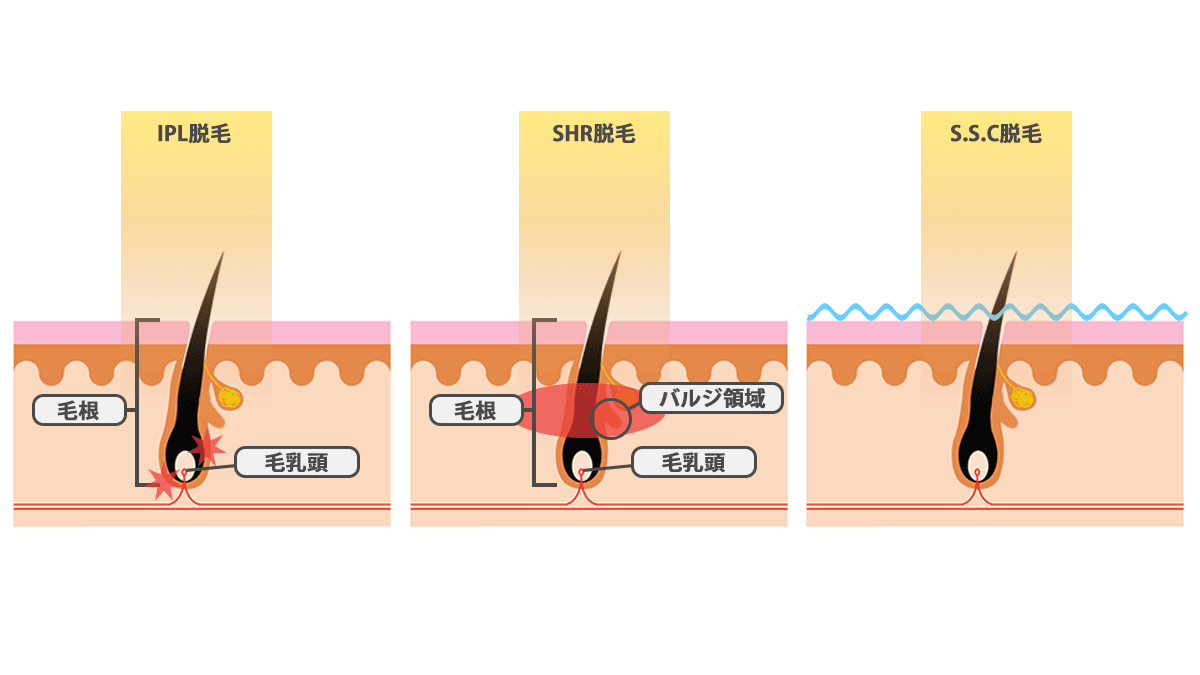 脱毛サロンで使用している3種類の脱毛方式